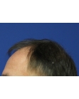 Before Hair Transplant&nbsp;Front